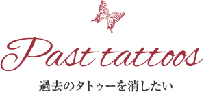 過去のタトゥーを消したい
