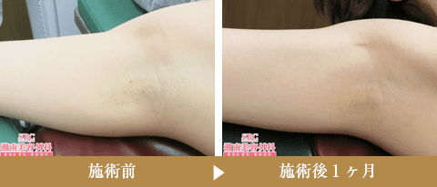 症例写真150213