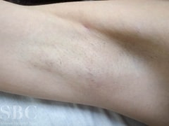症例写真