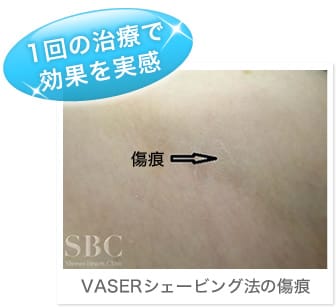 1回の治療で効果を実感