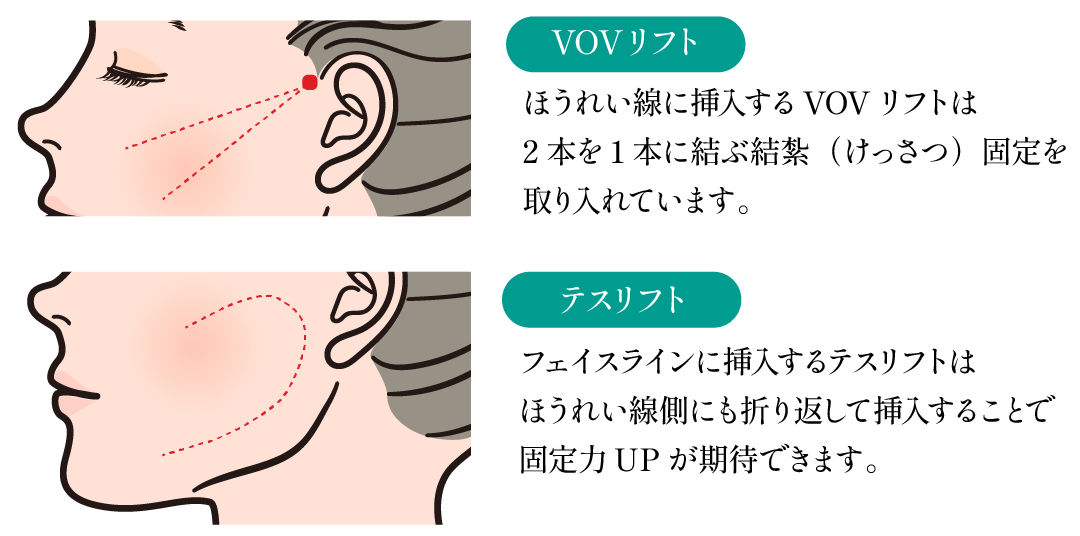 持続性を意識した糸リフトの工夫