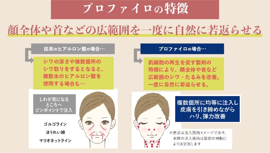 プロファイロの特徴について