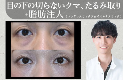 目の下の切らないクマ、たるみ取り+脂肪注入