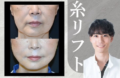 天王寺で糸リフトなら湘南美容クリニック大阪あべの院!