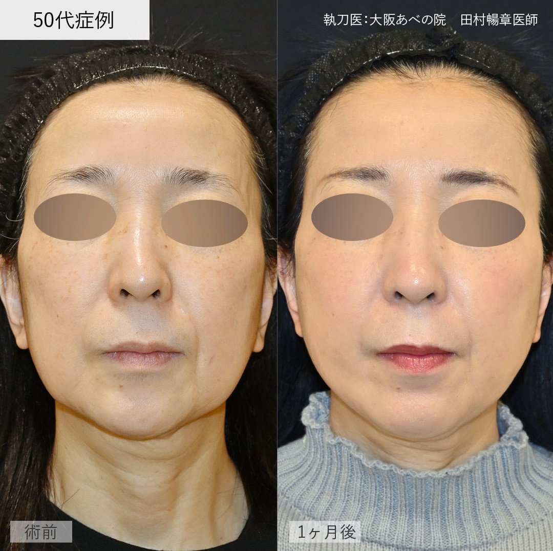 【50代女性】テスリフト4本＋シークレットリフト6本