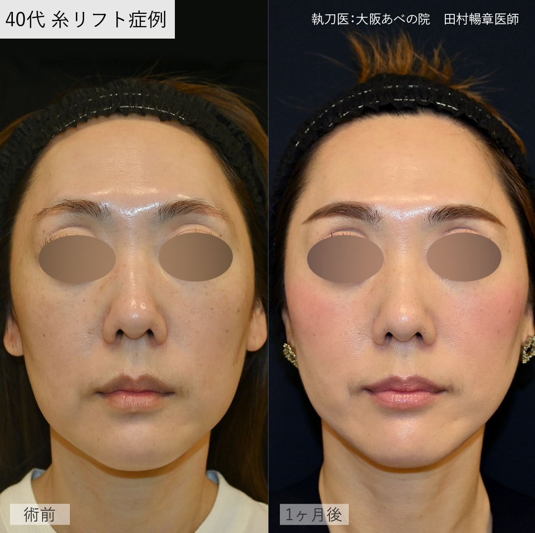 【40代女性】テスリフト6本＋シークレットリフト4本