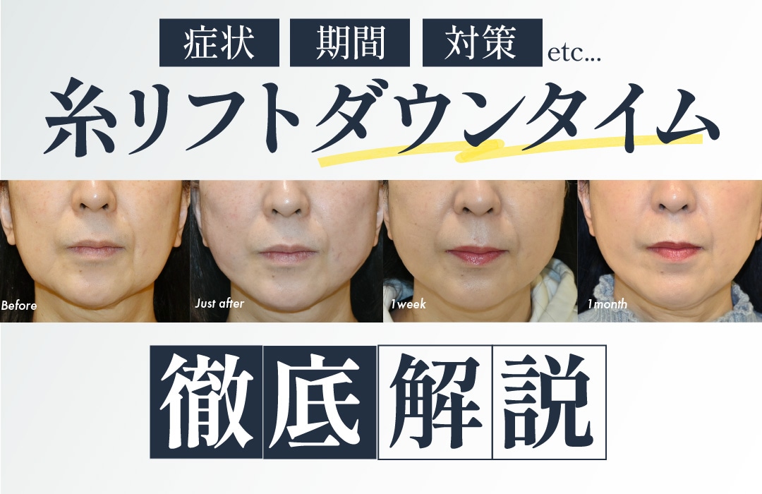 糸リフトのダウンタイムを徹底解説！症状や期間などをご紹介！