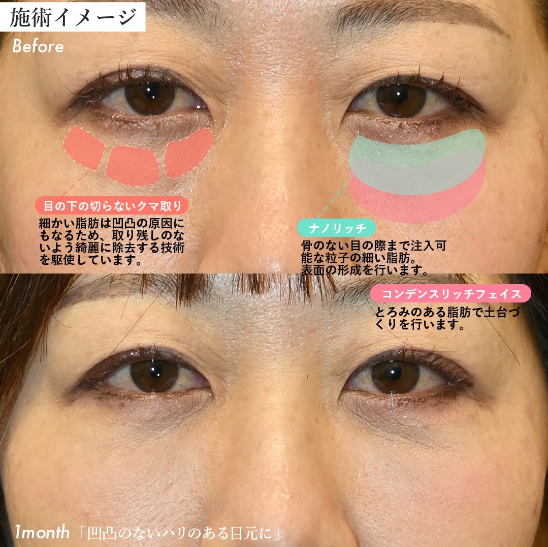 クマ取り＋脂肪注入