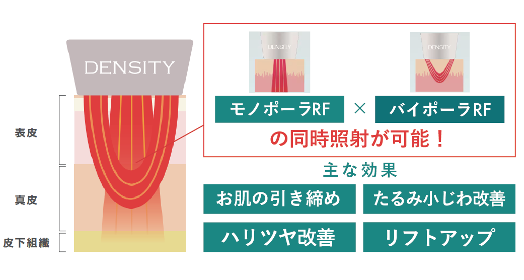 デンシティってどんな治療？