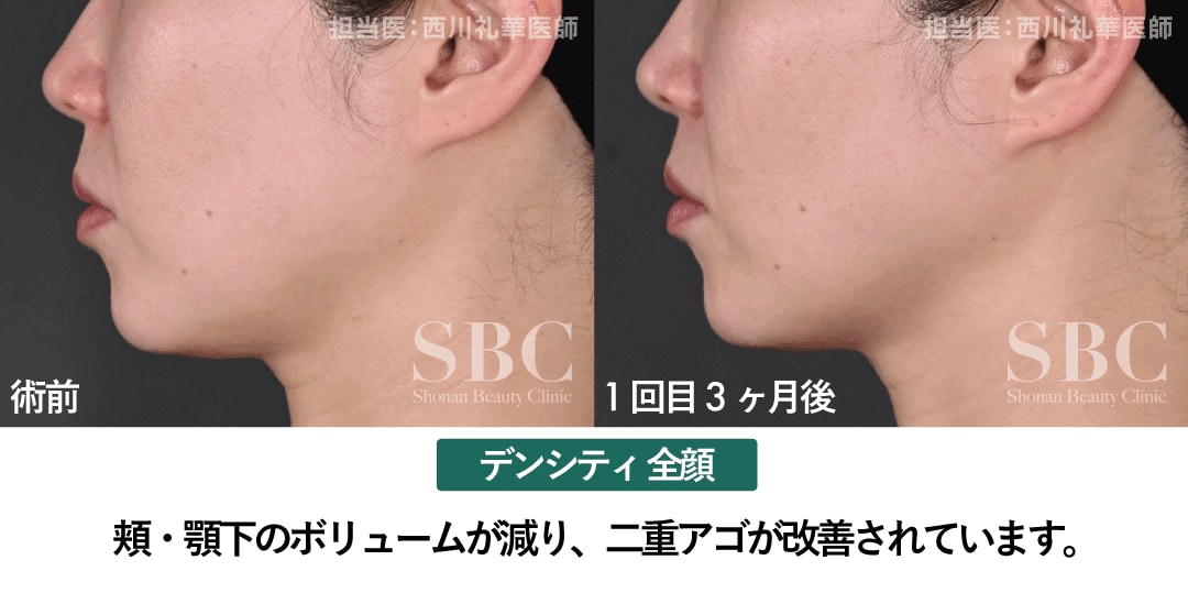 顔全体に照射