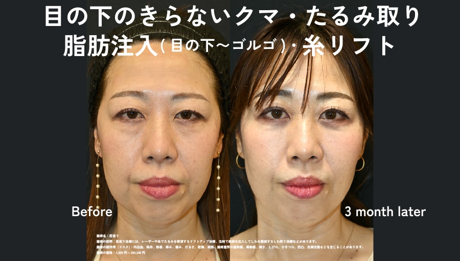 隠すメイクはもう終わり。コンシーラーいらずの明るい目元をGET！