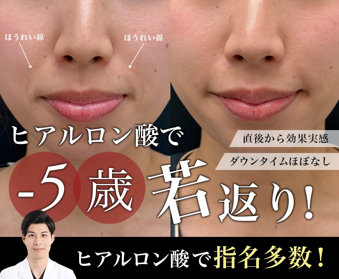 【ヒアルロン酸特集】ヒアルロン酸はドクター選びが重要！リピーター・指名多数の原田医師のポイントとは？