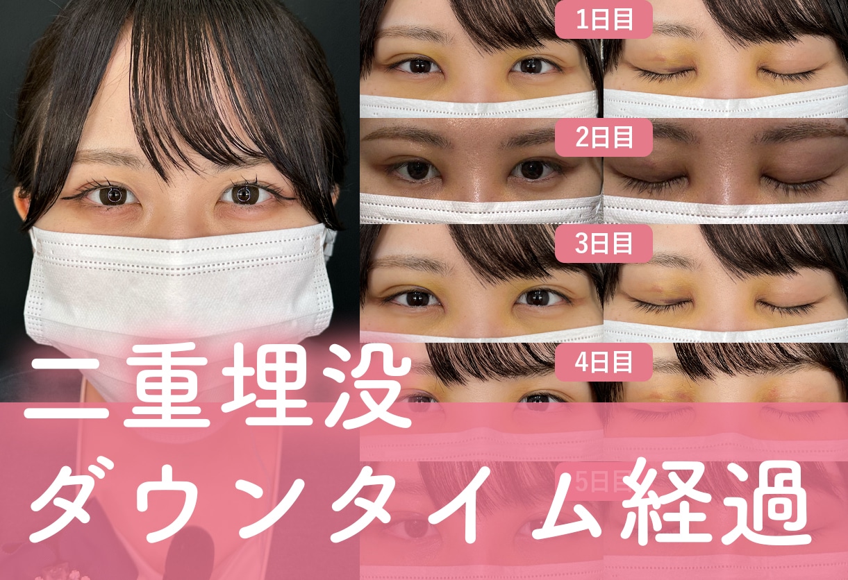 【二重ダウンタイム】埋没二重術のダウンタイムを徹底解説！術後の経過や過ごし方など解説いたします！