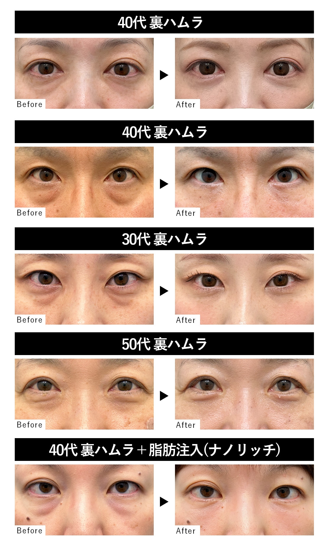 裏ハムラ法