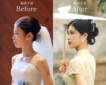 プレ花嫁さん必見！輪郭手術で最高のウエディングフォトを撮りたいスタッフに密着
