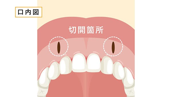 人工真皮の手術方法