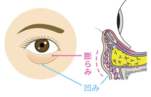 へこみ・影の限界