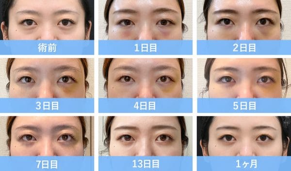 20代前半女性・脱脂＋脂肪注入