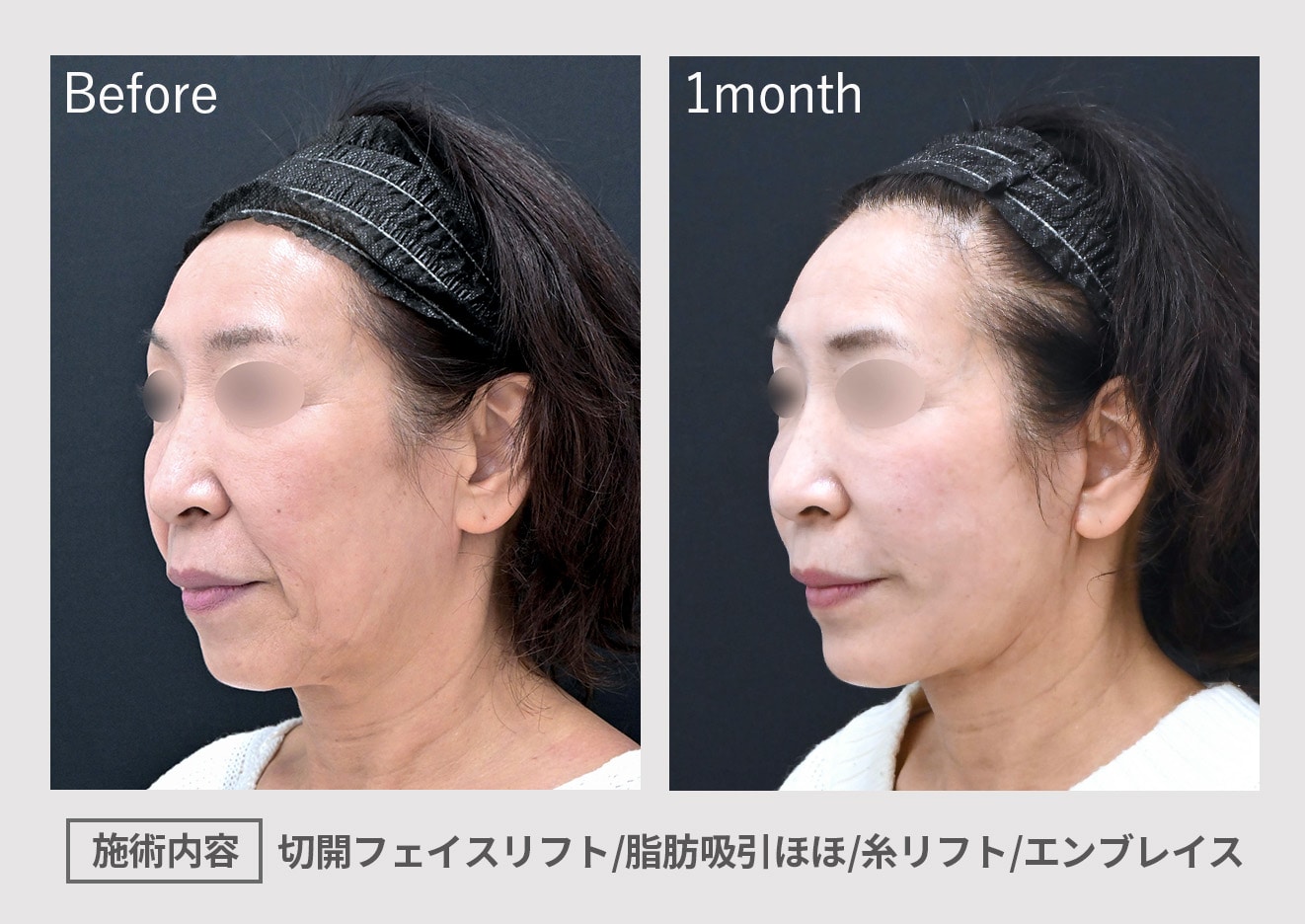 More Effective When Combined with Liposuction