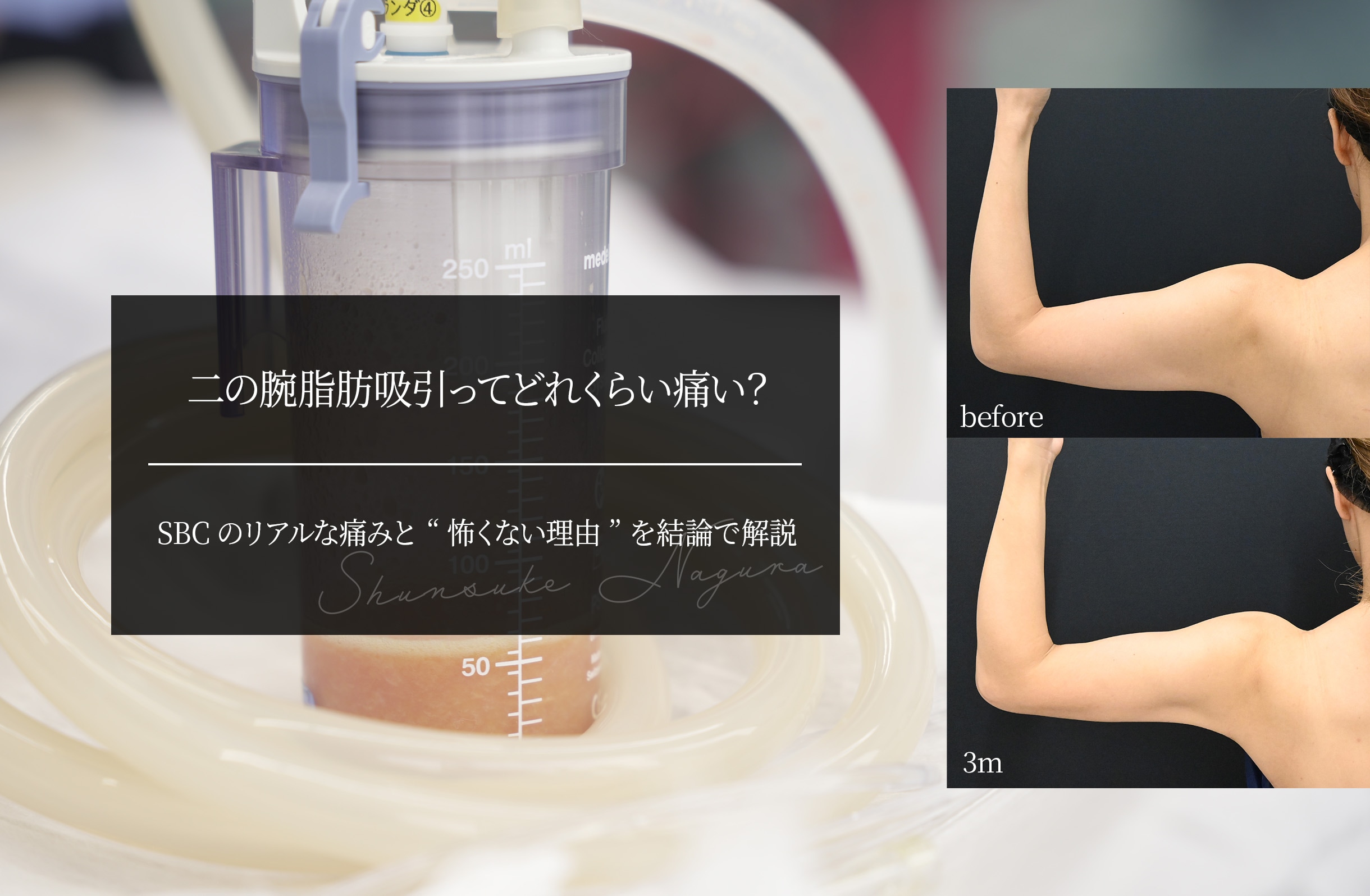 二の腕脂肪吸引ってどれくらい痛い？ SBCのリアルな痛みと“怖くない理由”を結論で解説
