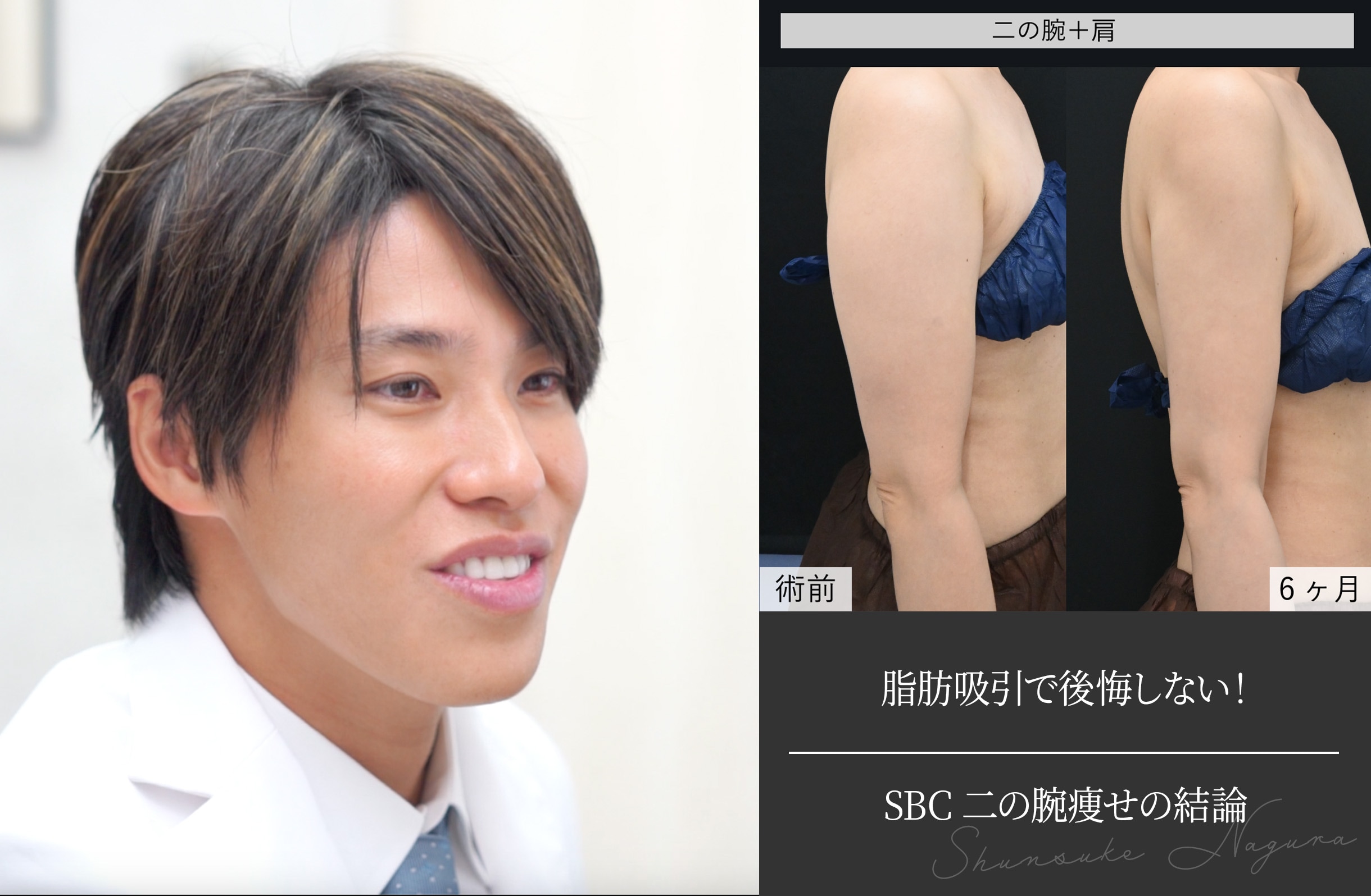 脂肪吸引で後悔しない！SBC二の腕痩せの結論