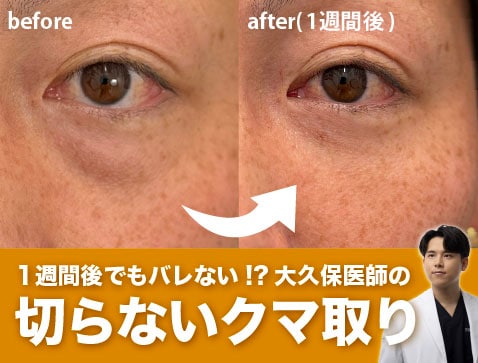 【クマ/目の下のたるみ】湘南美容クリニック秋田院でできるクマ取り