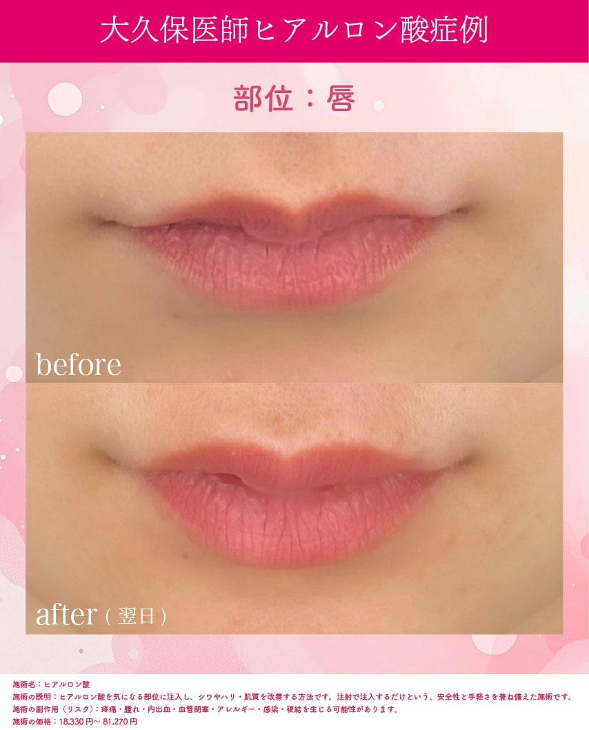 20代唇症例