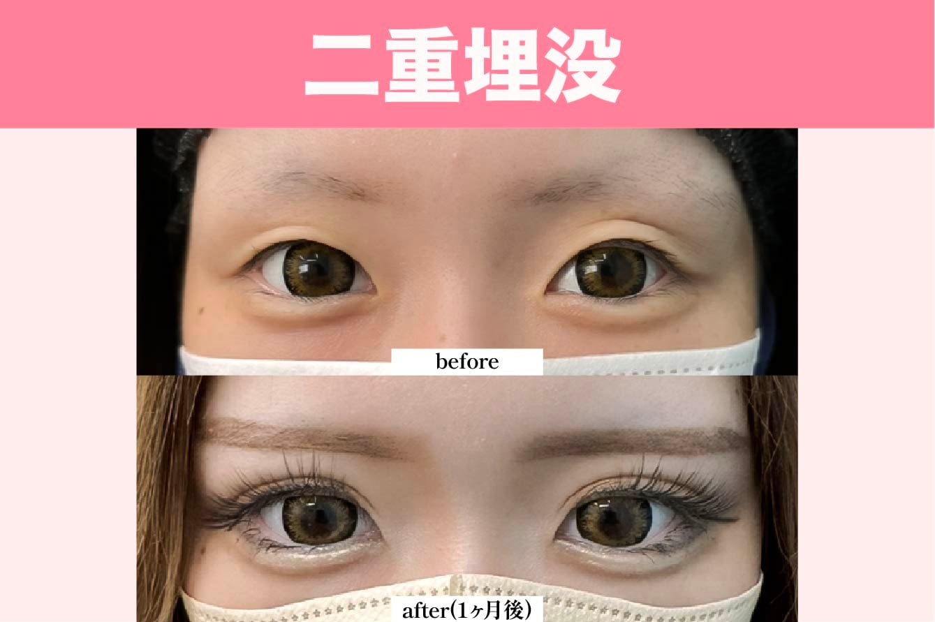 二重埋没