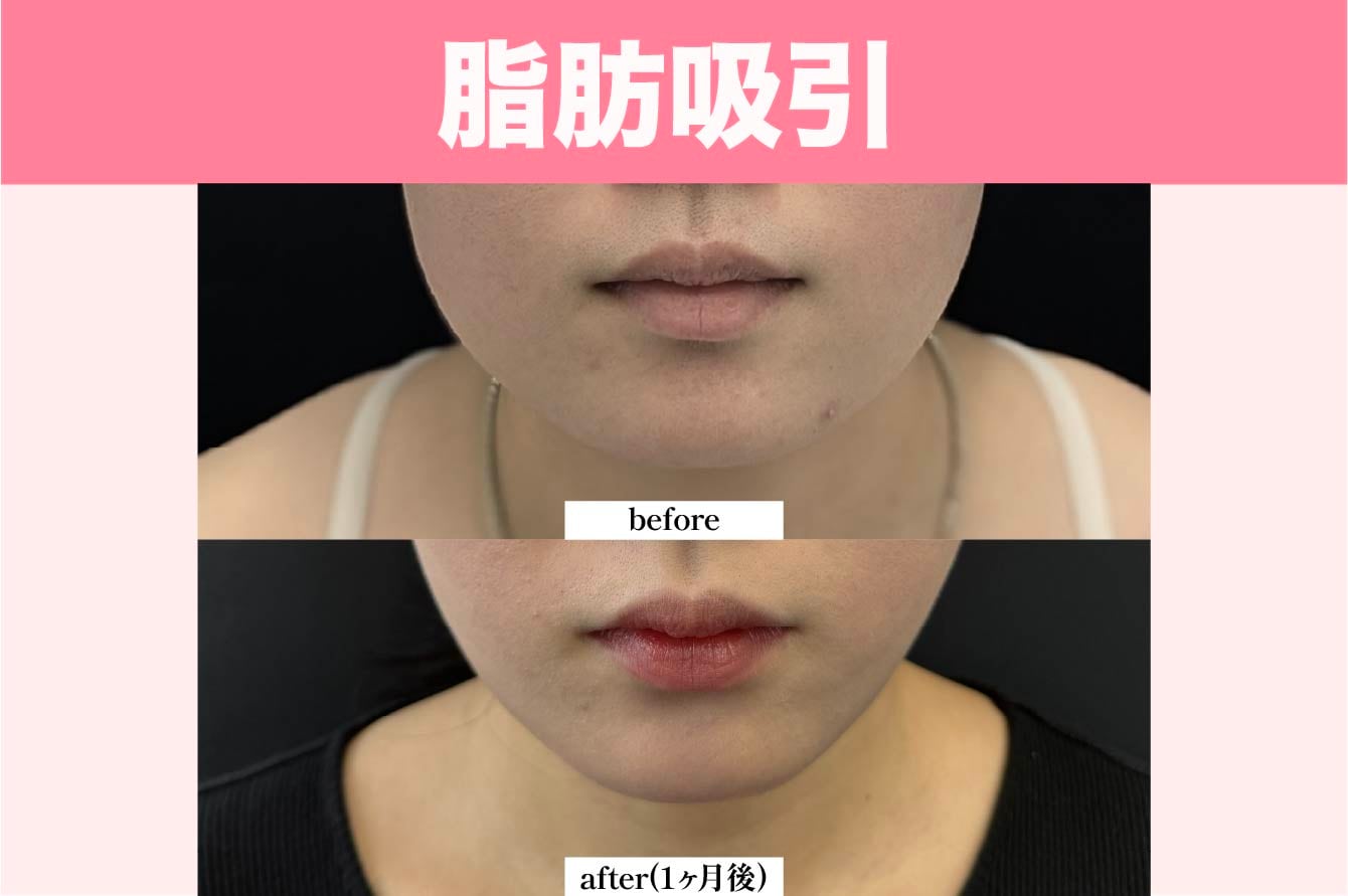 脂肪吸引