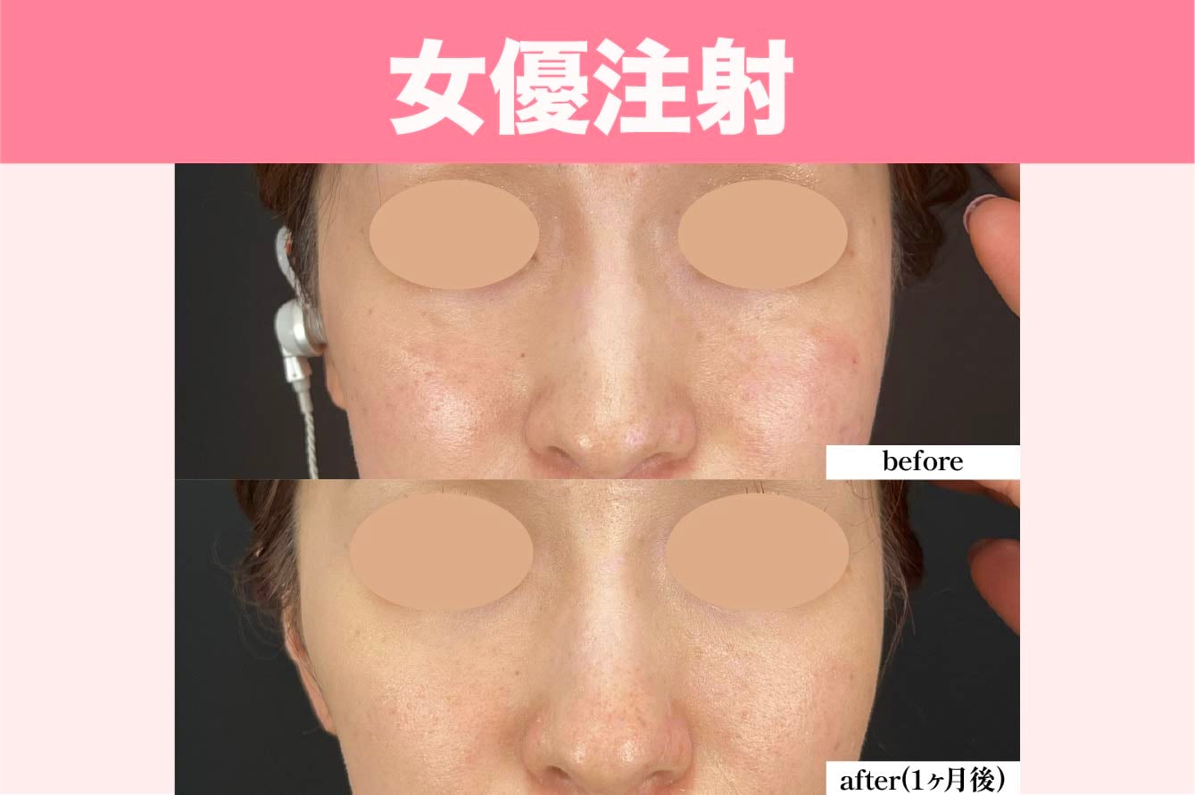 女優注射