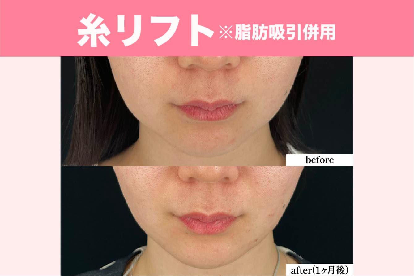 糸リフト
