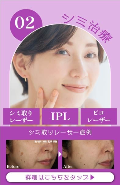 【シミ治療】シミによる老け見え解消✨