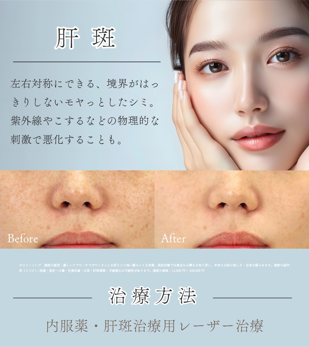 シミNo.3【肝斑】<br />

