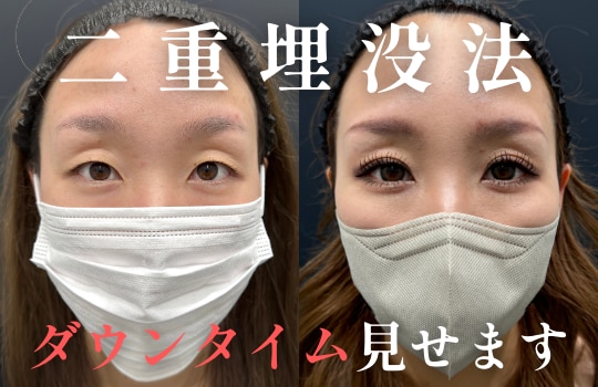 青森/弘前/八戸で二重整形するなら湘南美容クリニック青森院へ！