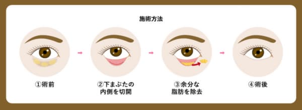 切らないクマ取りの施術方法