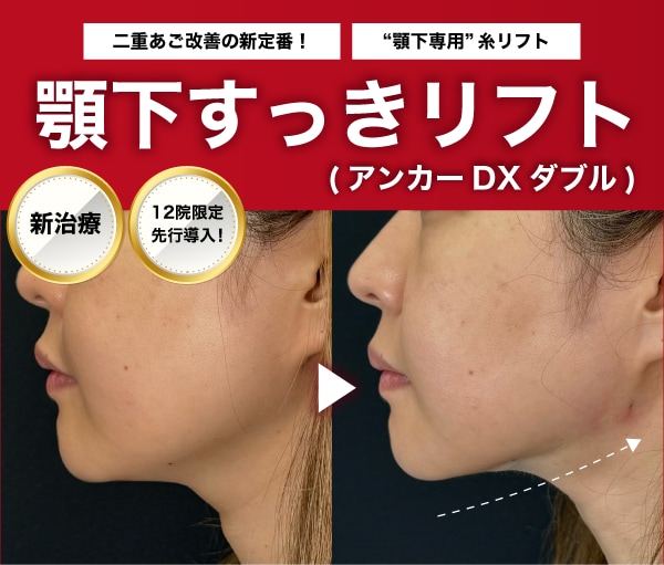 【新治療登場】二重あご・たるみにサヨナラ！「顎下すっきリフト」で叶える、誰もが羨むシャープな横顔｜千葉センシティ院