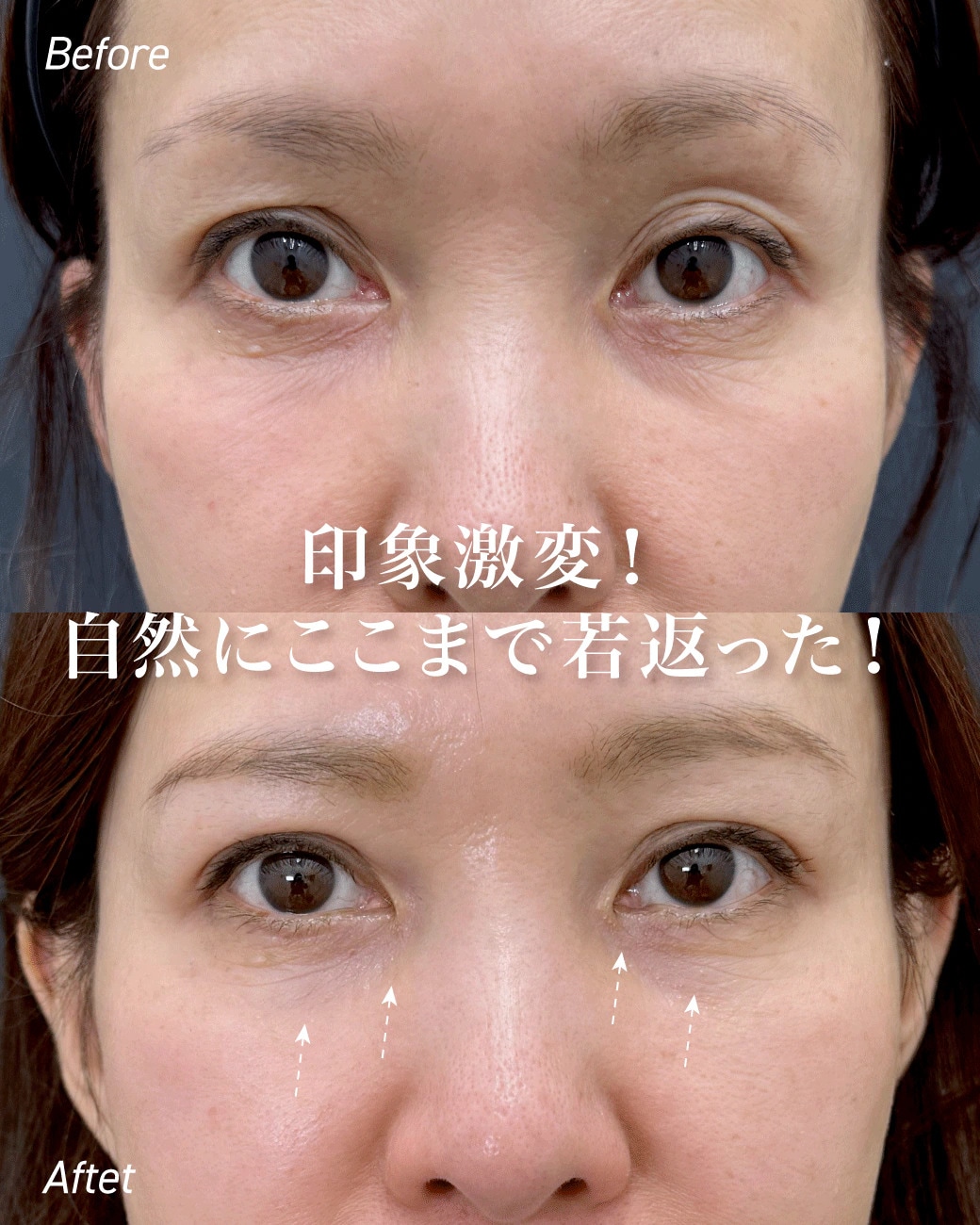 女優注射＆リジュラン。肌の内側から溢れる「ツヤ」
