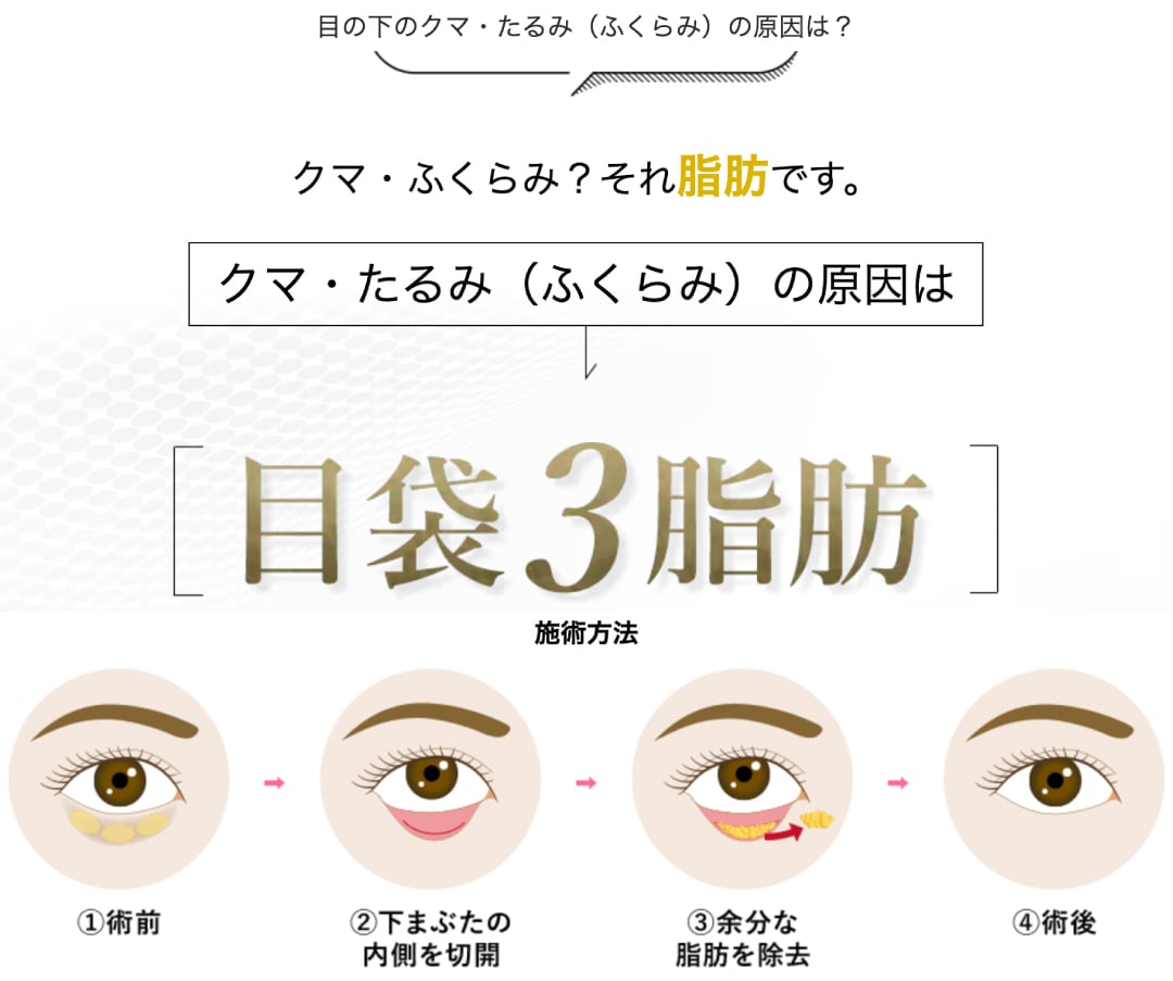 目の下の切らないクマ取り・たるみ（ふくらみ）取り