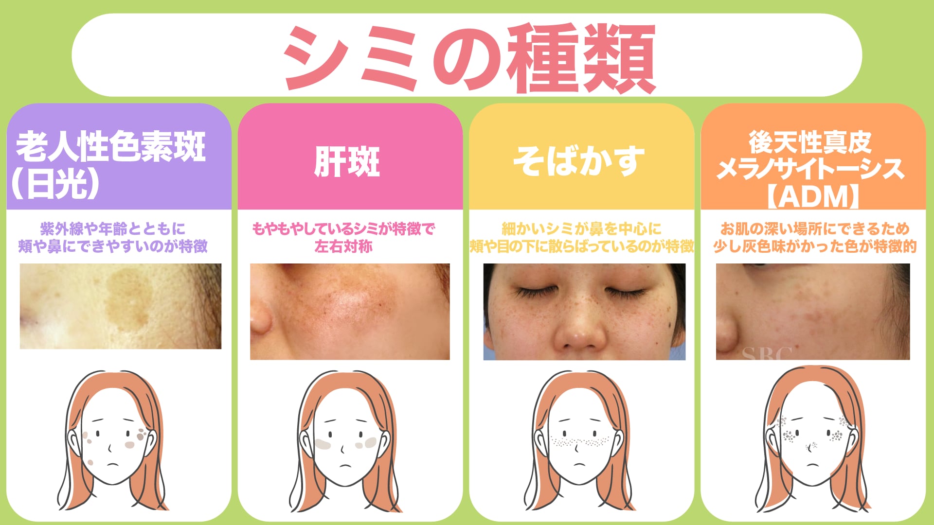 調布院で治療できるシミの種類