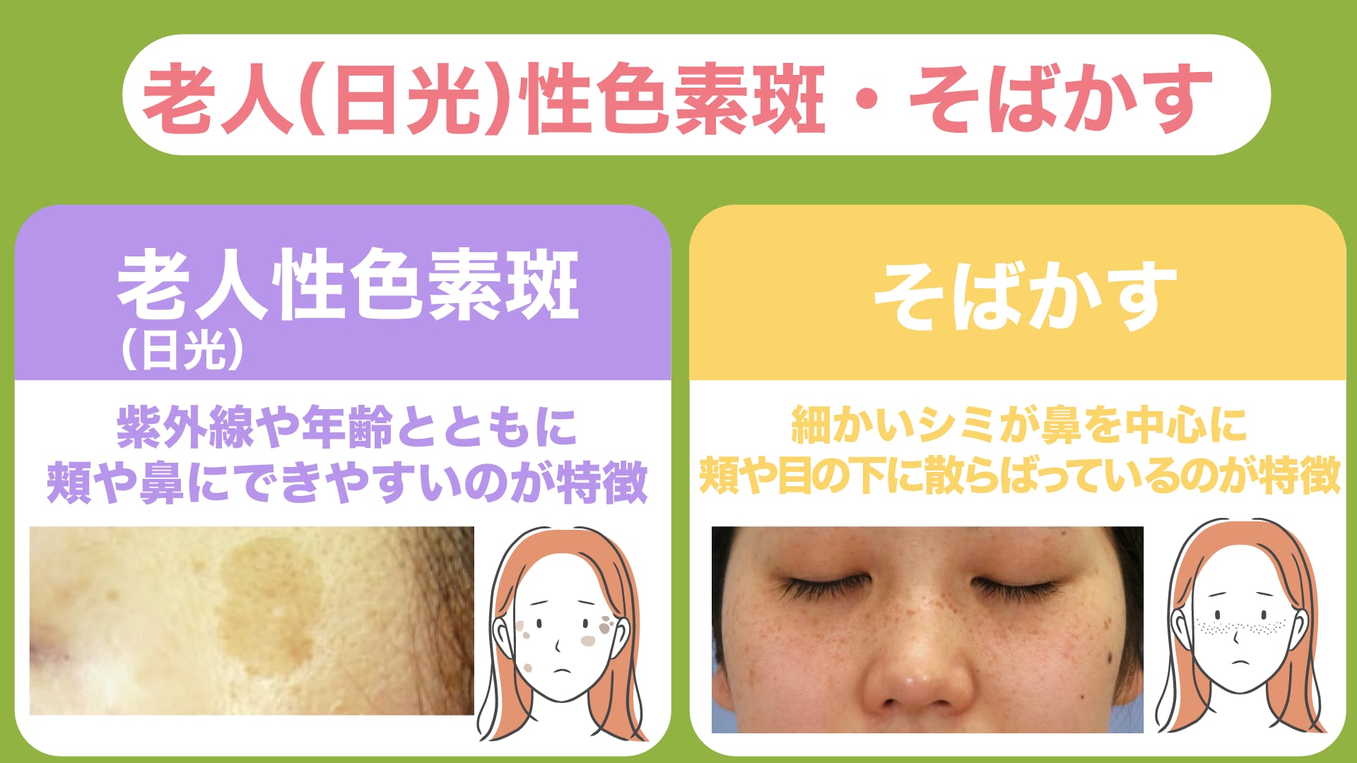 老人性色素斑・そばかすの原因と特徴