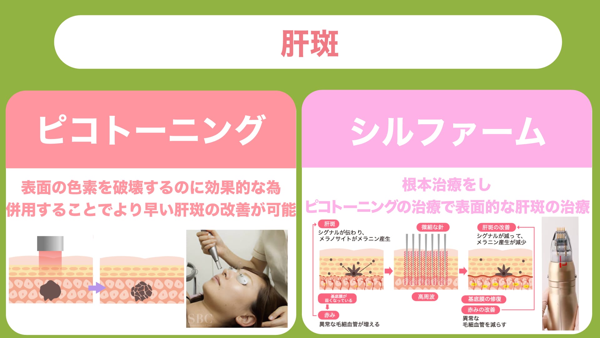 肝斑の治療法｜シルファームとピコトーニングの組み合わせ