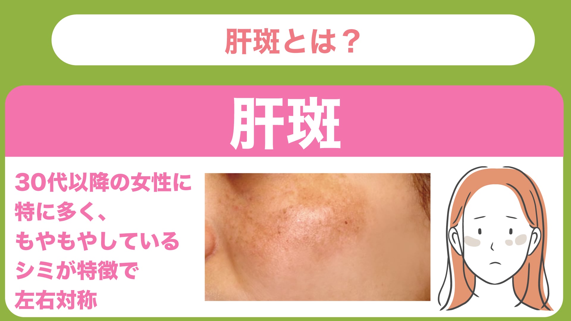 肝斑の原因と特徴｜レーザー選びに注意が必要なシミ