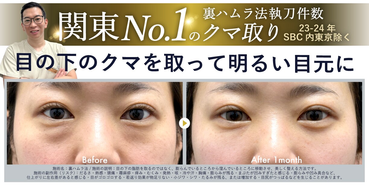 年末年始おすすめ美容治療 ①<br />
✨クマ取り（裏ハムラ法）✨