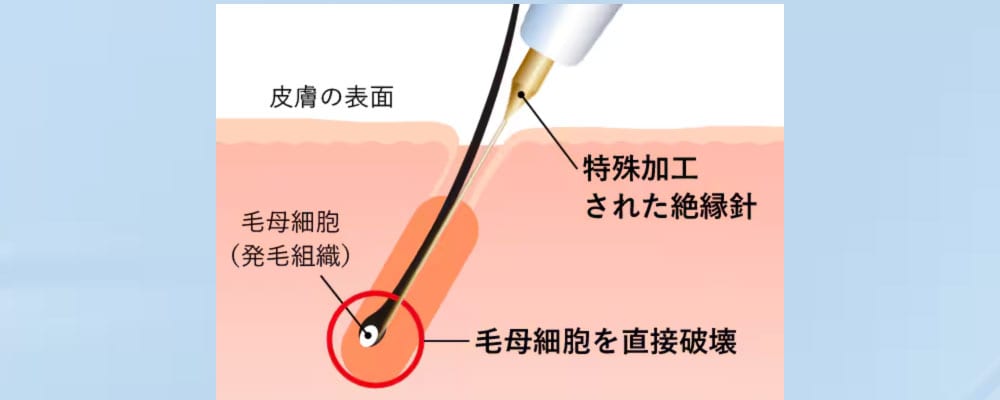 レーザーでは届かなかった「最後の一毛」・白髪にも対応