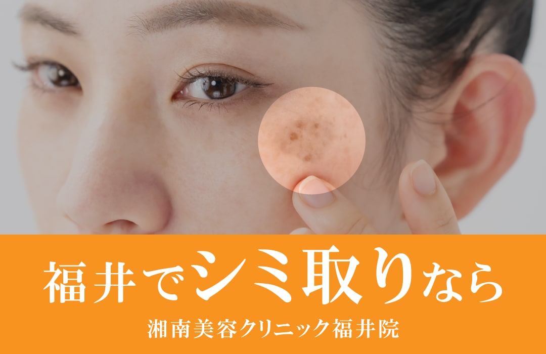 気になるシミのお悩みは湘南美容クリニック福井院へ✨【シミ】【そばかす】【肝斑】