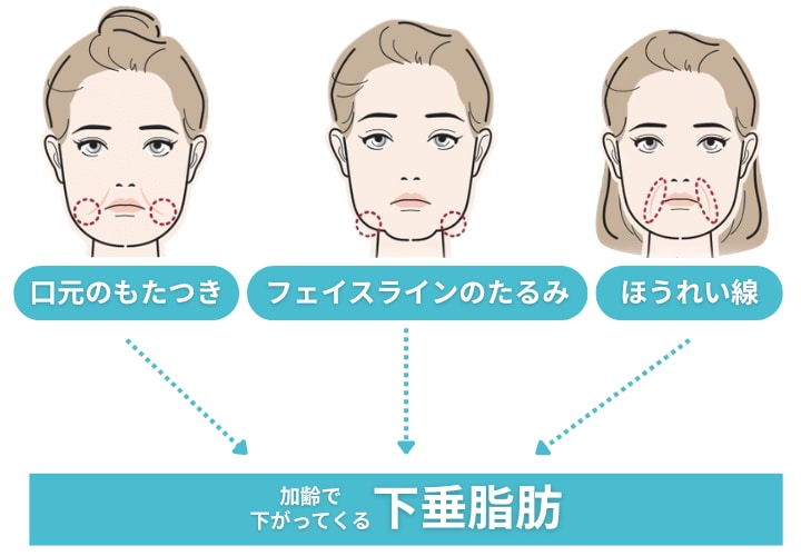 糸リフトって、どんな施術？<br />
