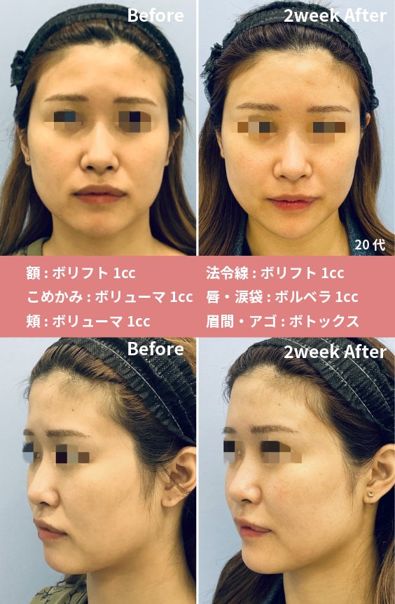 ヒアルロン酸×ボトックス(20代)<br />
