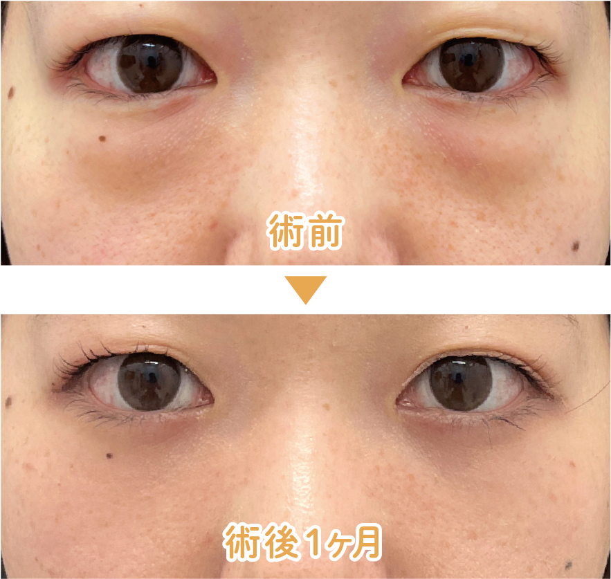 【20代後半 女性】目の下の切らないクマ・たるみ取り＋ナチュラル脂肪注射コンデンスリッチ（目の下〜ゴルゴ）