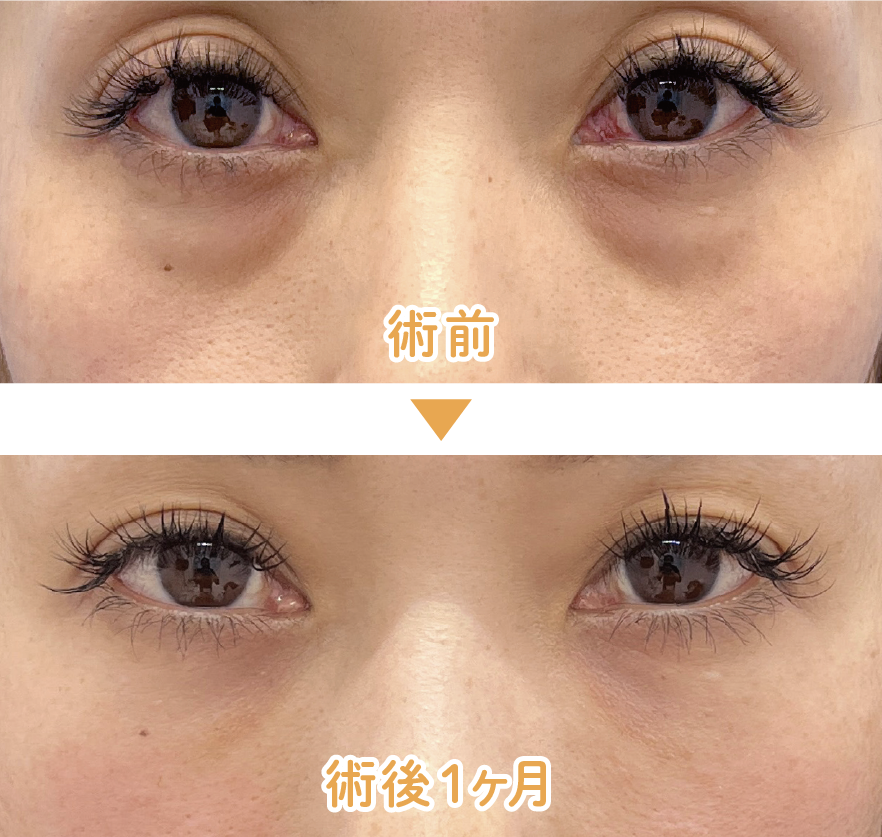 【30代後半 女性】目の下の切らないクマ・たるみ取り＋：ナチュラル脂肪注射コンデンスリッチ（目の下〜ゴルゴ）+ナチュラル脂肪注射ナノリッチ(目の下/目の上）