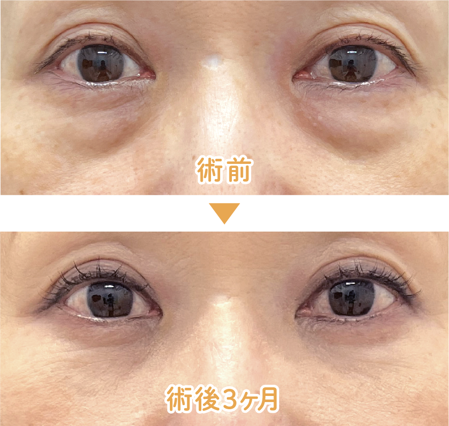 【50代前半 女性】目の下の切らないクマ・たるみ取り＋ナチュラル脂肪注射コンデンスリッチ（目の下〜ゴルゴ）+ナチュラル脂肪注射ナノリッチ(目の下/目の上）